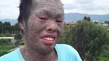 Ma peau est en train de me tuer