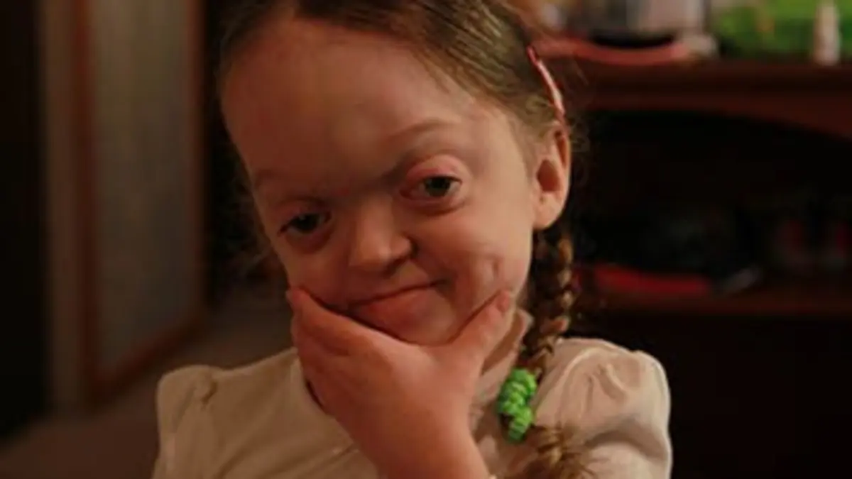 Body Bizarre S02E01 Tumeur faciale et corps de géant