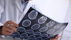 Diagnostic : sclérose en plaques