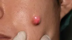 Dr Pimple Popper Tendre l'autre joue