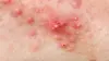 Dr Pimple Popper: This is Zit