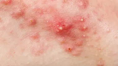 Dr Pimple Popper: This is Zit A Work of Art