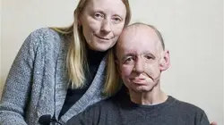 Embarrassing Bodies Special The Man With Half a Face