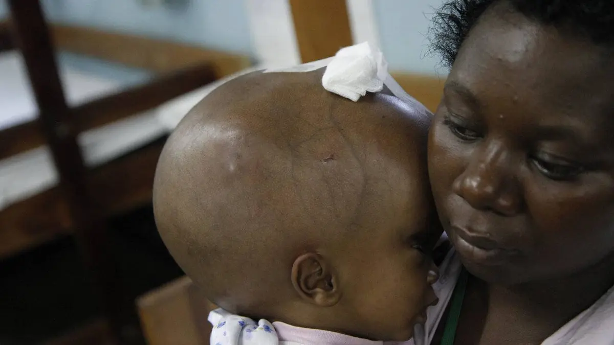 Hydrocéphalie: opération espoir