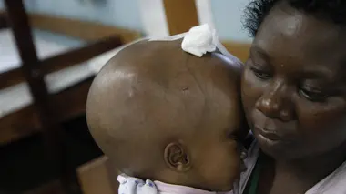 Hydrocéphalie: opération espoir