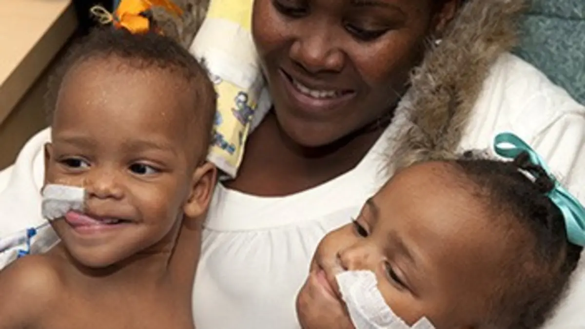 Jumelles siamoises : la grande opération