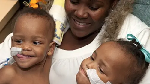 Jumelles siamoises : la grande opération