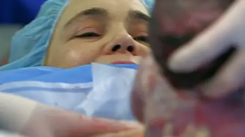 Casting La césarienne : une pratique controversée