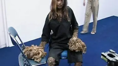 Extraordinary People L'incroyable histoire de l'homme arbre