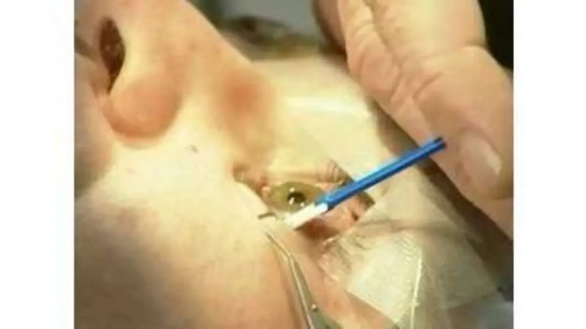 Comment c'est fait - La Chirurgie des Yeux au…