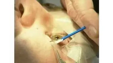 Comment c'est fait - La Chirurgie des Yeux au Laser