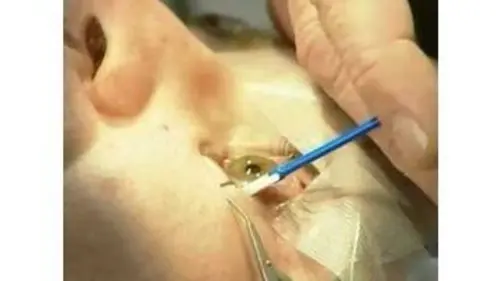 replay de Comment c'est fait - La Chirurgie des Yeux au Laser