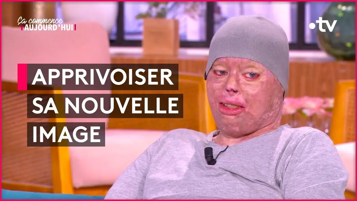 replay de Grands brûlés : quelle vie après ? - Ça commence aujourd'hui