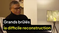 Le 1945 : La difficile reconstruction des grands brûlés