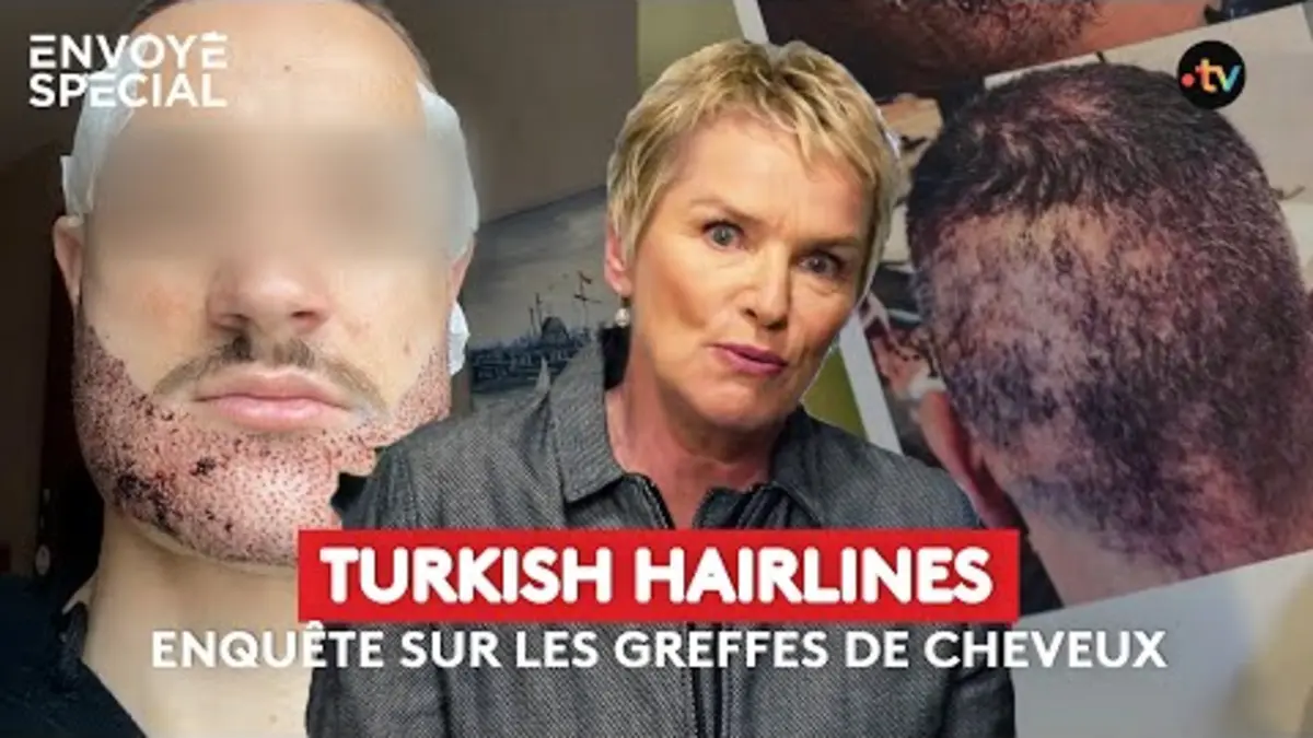replay de Turkish hairlines, enquête sur la greffe de cheveux