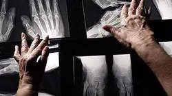 Visuel de Rhumatismes, pourquoi ça coince ?