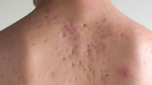 SOS Dermato Acne Special: Miya, Rishi, Chloe & Jordan