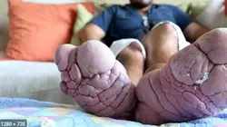 SOS pieds en détresse Pieds d'alligator