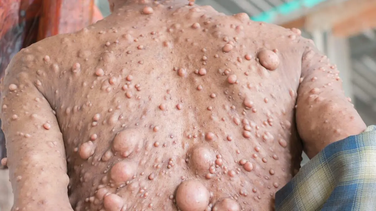 Tumeurs extrêmes : chirurgiens à la rescousse Un millier de tumeurs