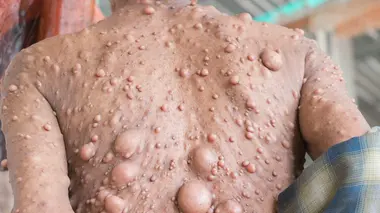 Un millier de tumeurs