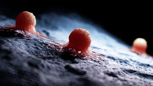 Tumeurs extrêmes : chirurgiens à la rescousse